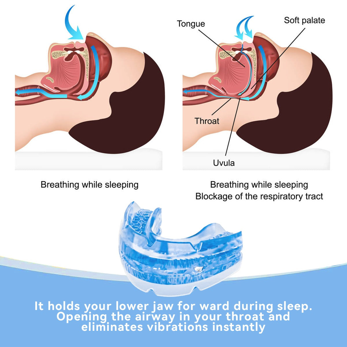 Anti-snoring mouthpiece (Night Teeth)